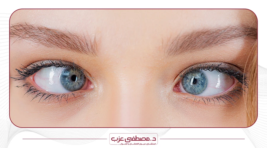 طريقة علاج حول العين