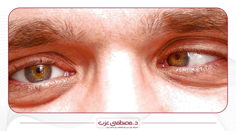 علاج حول العين اليسرى عند الكبار