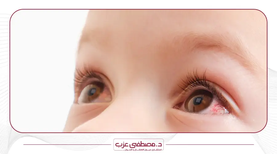 اسباب احمرار العين عند الاطفال