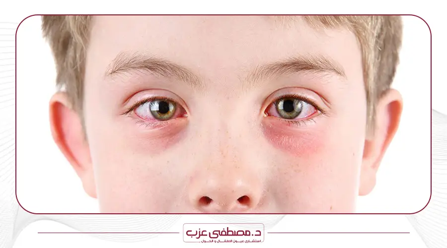 علاج احمرار العين عند الاطفال