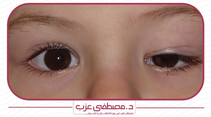 عملية ارتخاء الجفن عند الاطفال