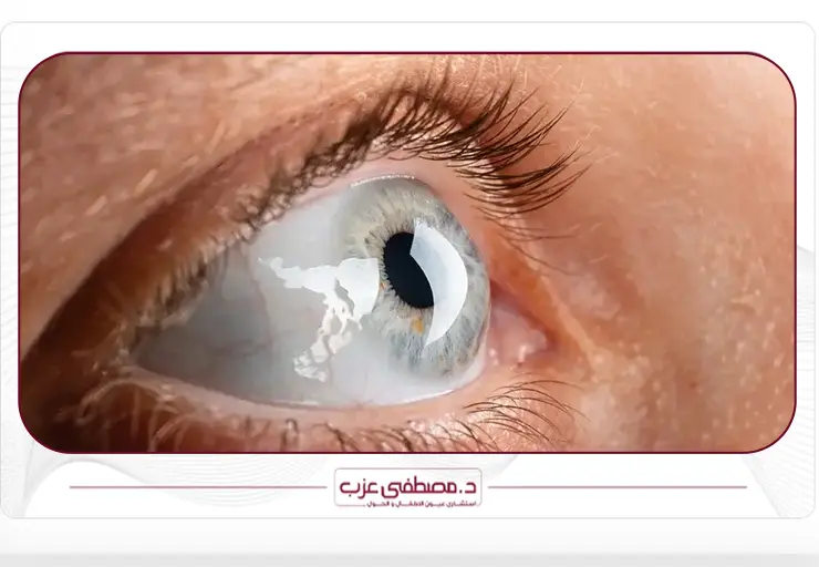 هل المياه البيضاء تسبب العمى