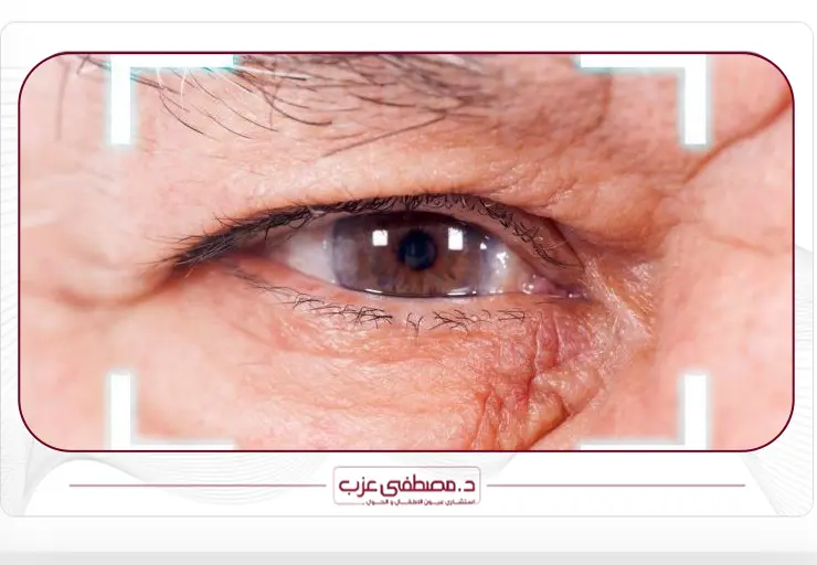 أنواع المياه البيضاء في العين